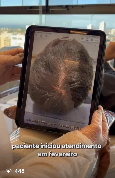 Caso masculino de calvície na região da coroa